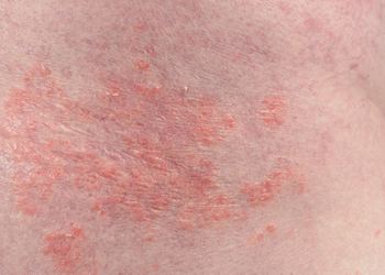 Producten voor eczeem en psoriasis